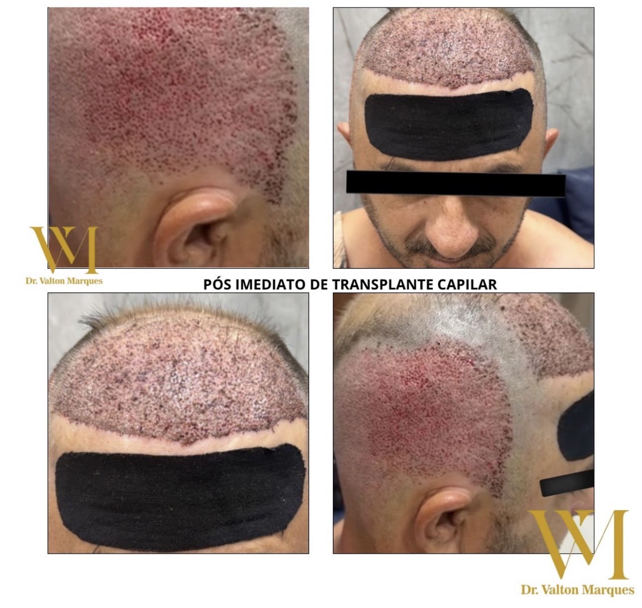 Pós imediato de transplante capilar