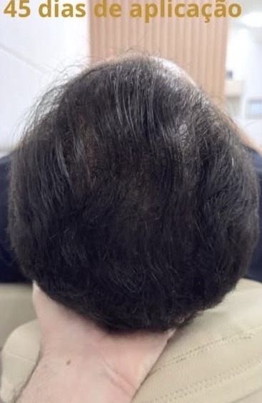 Mesoterapia capilar — antes e depois