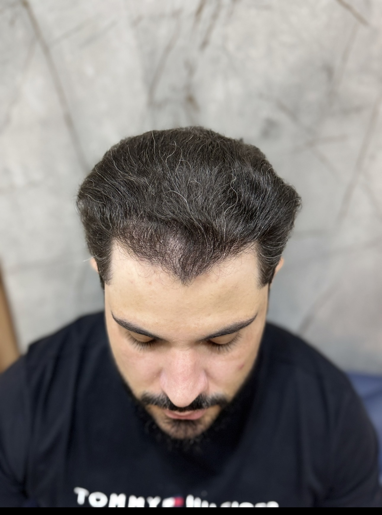 Dr. Valton Marques — depois do próprio transplante capilar