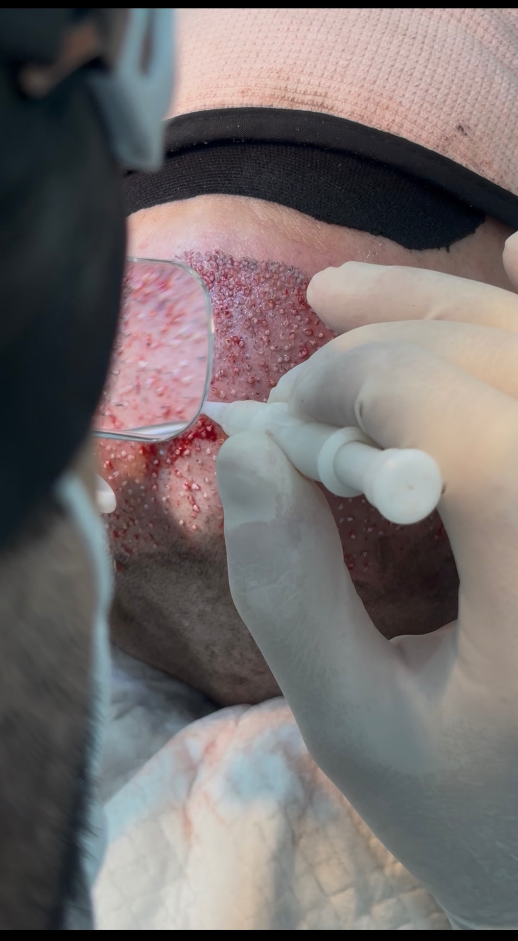 Dr. Valton Marques realizando transplante capilar — registro 3