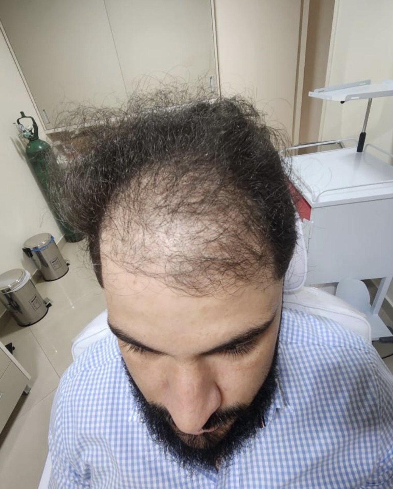 Dr. Valton Marques — antes do próprio transplante capilar