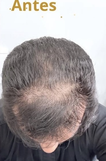 Mesoterapia capilar — antes e depois